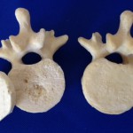 Kyphoplasty WS Bone